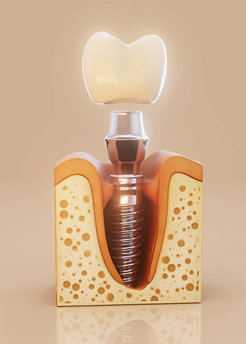Dental Implant